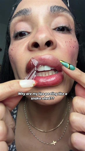 Understanding Peeling Lips and Remedies