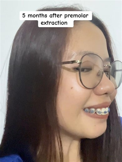 Braces Journey: 5 Months After Premolar Extractions