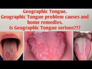 Geographic Tongue.Geographic Tongue problem causes and home remedies.Is Geographic Tongue serious???
