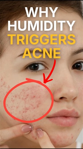Why Does Your Skin Break Out More When It's Humid 🤔