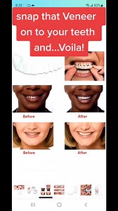 ✨️😁 How To Use Snap On Smile Veneer Correctly ✨️✨️ #snaponsmile #vene...