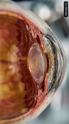 Liang Jung 梁世融 | Progressão de cristalino para catarata. Credit to @lidemka Cataract growth from a generative visualisation master 🤘#cataract... | Instagram