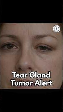 Upper Eyelid Swelling? Serious Eye Problem You Must Know!