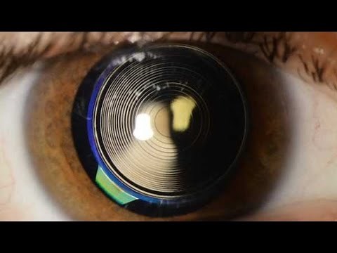 Wie funktionieren Multifokallinsen-Implantate? - Dr.med. Amir-Mobarez Parasta | MUNICH EYE