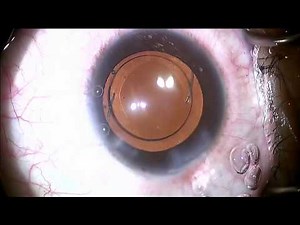 3 Piece Intraocular Lens Insertion
