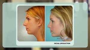 Facial Liposuction & Thermi RF