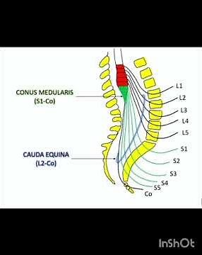 Difference between Conus Medullaris and Cauda Equina syndrome