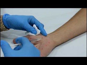 Hiperhidrosis palmar. Procedimiento con Botox