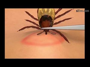 How to safely remove a tick