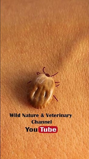 Blood-Engorged Tick Feeds from Human Vein – Close-Up of Parasite Behavior & Bloodsucking Process