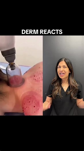 #DermReact cupping #dermatologist #skintok #dermtok #cupping