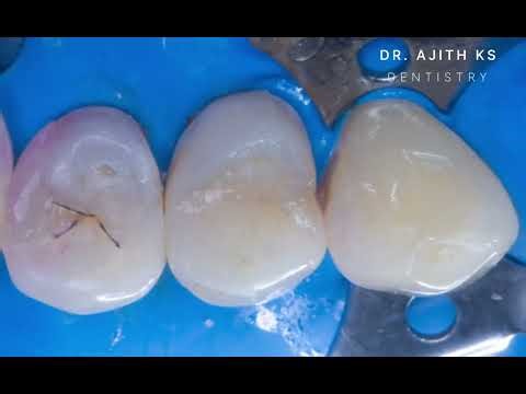 Simple Class 2 Direct Composite Restoration (with BIOCLEAR matrix system)