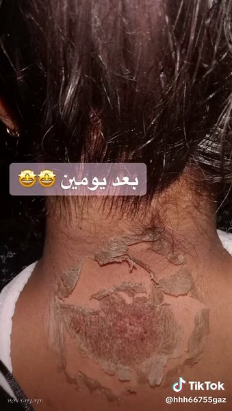 Skin Care Procedure: Flaky Skin Removal Explained