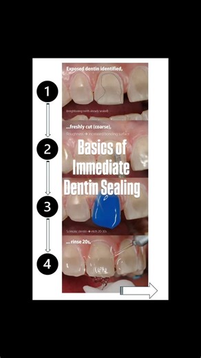 Pascal Magne on Instagram: "Basics of IDS with OPTIBOND FL based on almost 30 years of experience. If you are using the unidose rocket system, you can also preheat your primer and adhesive in Calset at 68C for 10 minutes before use to get 20% improvement."