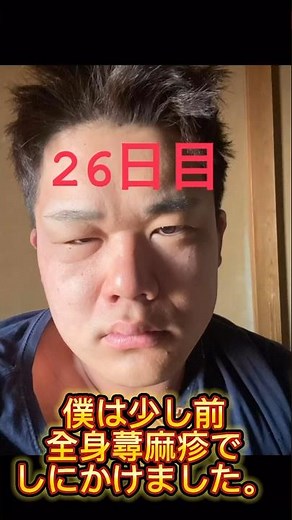 全身蕁麻疹の原因判明 気をつけよう！#ダイエット