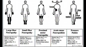 Neuropatía axonal y neuropatía desmielinizante. - ENFERMEDAD 2026