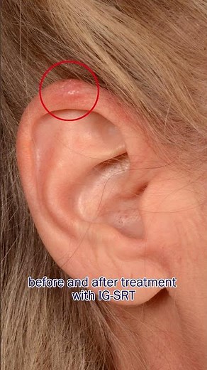 Image Guided Superficial Radiation Therapy - This Week at Haber Dermatology