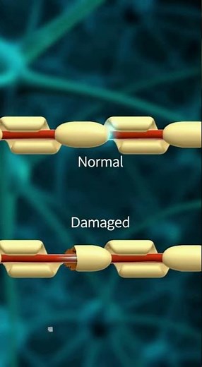 Multiple Sclerosis Explained: How Myelin Loss Disrupts Nerve Signals and Damages the Nervous System
