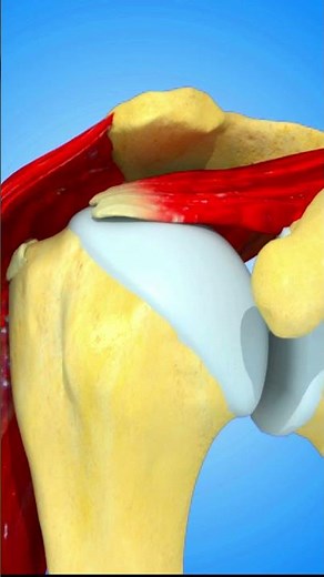 MRI Interpretation: Full Thickness RCT Diagnosis