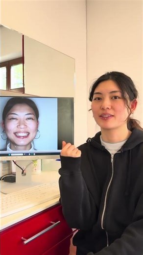 Invisalign review 😍 Faster than expected! | Before and after progress report