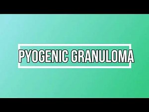 Pyogenic Granuloma: History, Clinical and histological features (Pregnancy tumor), DD & Treatment