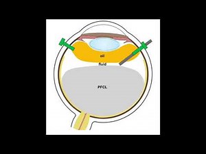 Fully Automated Direct Perfluorocarbon Liquid-Silicone Oil Exchange