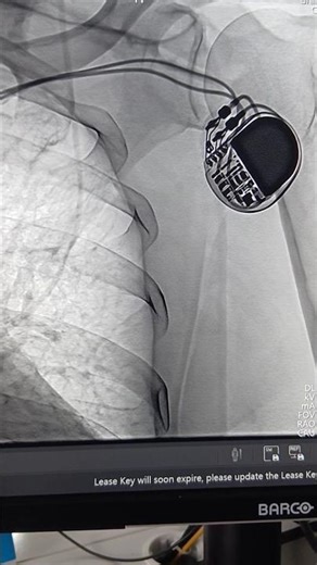 Dual-Lead Pacemaker. Elektrokardiostimulyator.