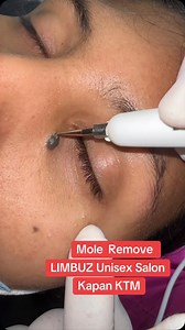 1.1K views · 60 reactions | Mole removal #limbuzsalon #bhrikutichowk #kapan #ktm #nepal #tirthalimbu #beuty #moleremoval | Limbuz Unisex Salon | Facebook