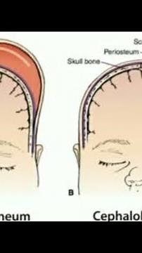 Caput succedaneum vs cephalhematoma