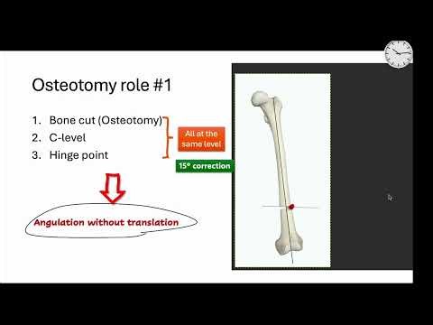 Osteotomy rules in deformity correction