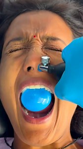 🏆CFR for Facial Pain The term “CFR balloon treatment” most commonly refers to Cranial Facial Release (CFR), an alternative chiropractic technique that uses small balloons inserted into the nasal passages to adjust the bones of the face and cranium. (at this time, I do not perform this treatment. Sharing for educational purposes only.) #Repost @mr.yogeshmahale #chiropractor #cor #reelsvideo #reelsviral #migraine #virals #trending | Dr_kyleross