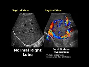 Liver Ultrasound Pathology | Normal USG Image #liverultrasoundpathology #usg #liverdiseases