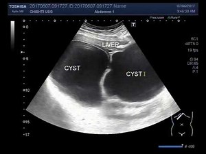 Ultrasound Video showing two large hydatid hepatic cysts.