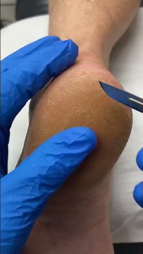 Thick Heel Callus Removal by Australian Podiatrist | Effective Treatment for Calluses and Corns