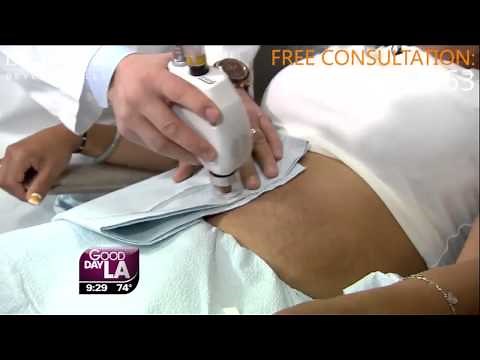 Stretch Mark Removal TV Demo