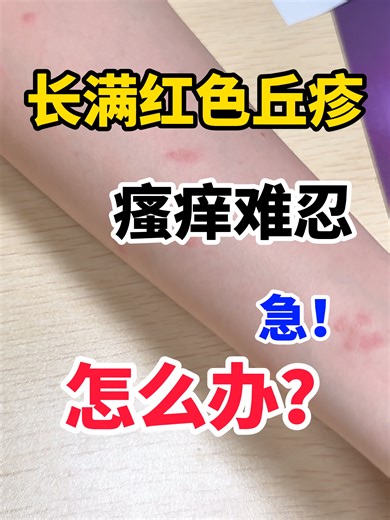 长满红色丘疹 瘙痒难忍