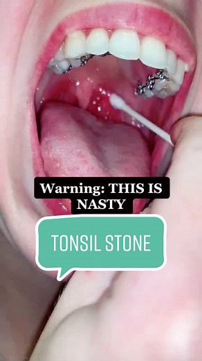 #stitch with @feistymeerkat #tonsilstones #tonsilstonesremoval #tiktokdoctor #tiktoksurgeon #badbreath #fyp #learnontiktok #earnosethroat