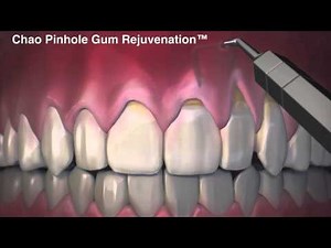Chao Pinhole Gum Rejuvenation - Chao Pinhole Surgical Technique