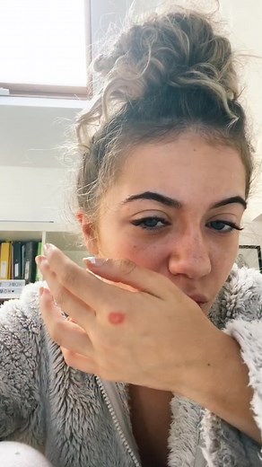 woke up with this on my hand #fyp #irish #viral