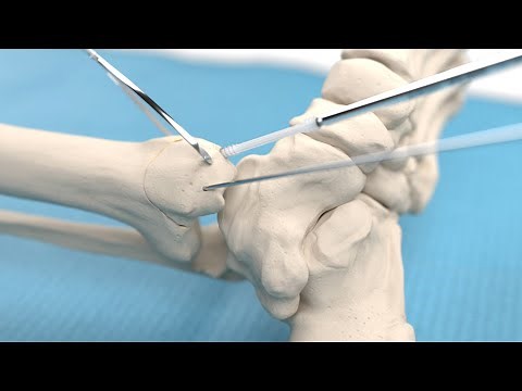 Medial malleolar osteotomy and talar osteochondral fragment fixation using bioabsorbable screw