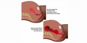 Postpartum Hemorrhage - RNpedia