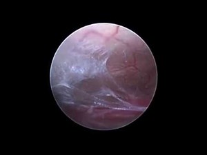 Endoscopic Third Ventriculostomy (ETV) for congenital hydrocephalus