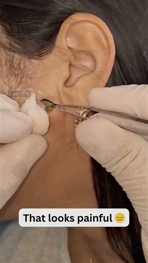Deep Blackheads, Milia & Whitehead Removal pimple popping New| Big Cystic Acne Extraction #1231 2026