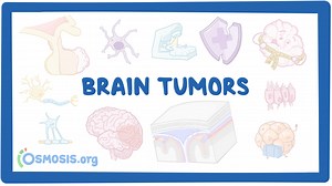 Brain tumors: Nursing: Video & Causes | Osmosis