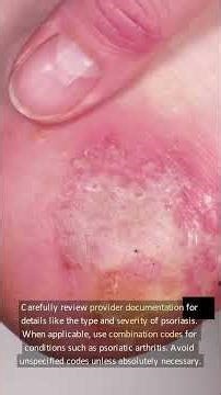 Medical Coding Psoriasis Essential Guidelines