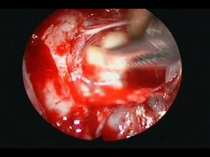 TSHoma - Pituitary Adenoma • Video • MEDtube.net