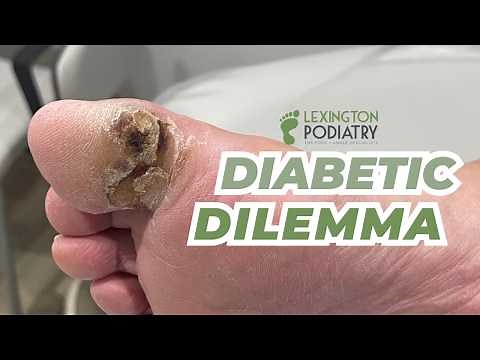 Diabetic Dilemma | Year Old Ulcer