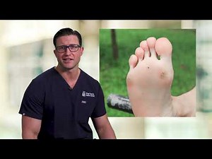 Ask The Doctor: Corns, Calluses & Warts...What Are They?