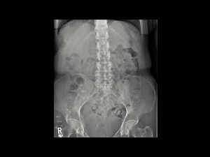 Sitz marker study for delayed bowel transit