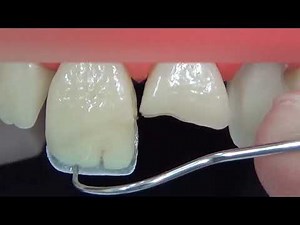 Direct restoration of the front tooth in 3 minutes | TIME LAPSE . Anterior tooth restoration